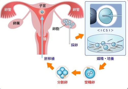 揭秘辅助生殖技术—试管婴儿